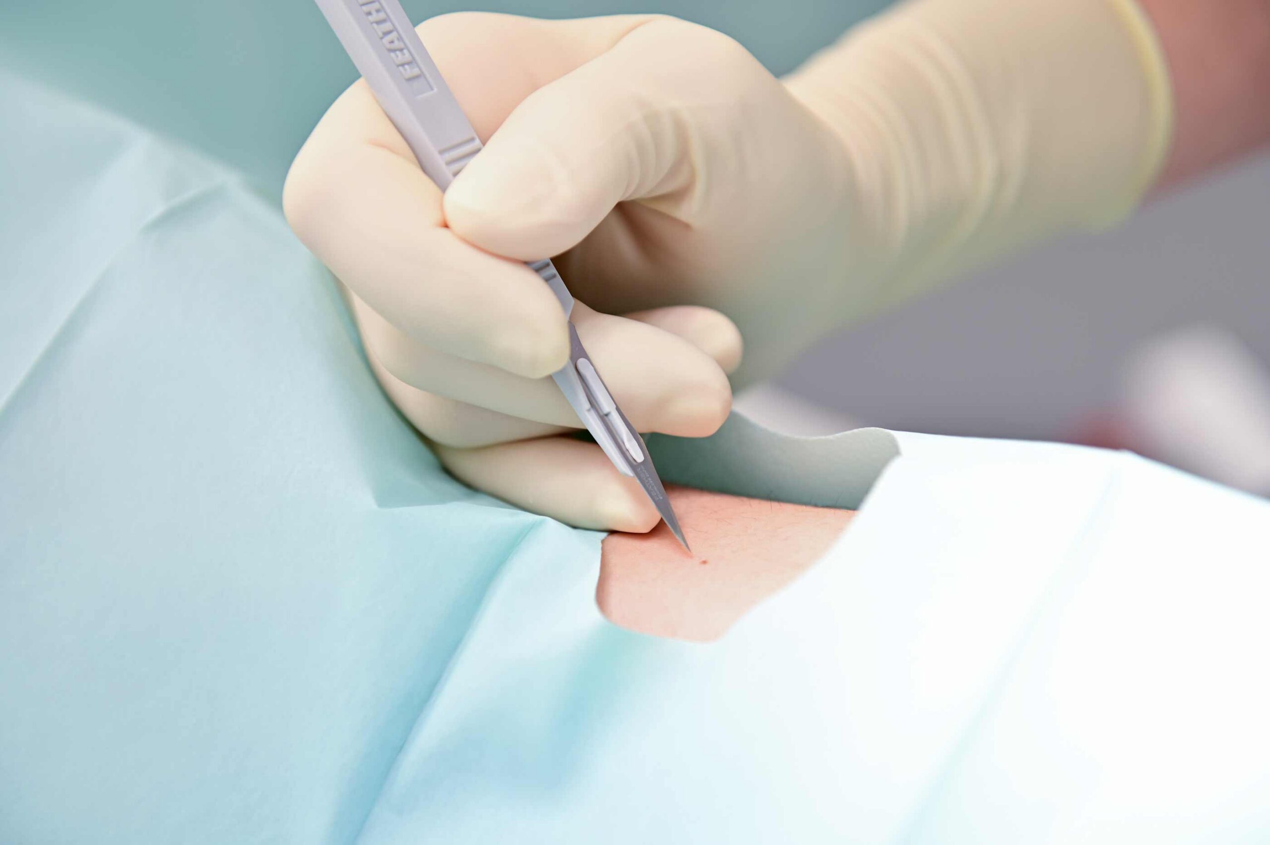 skin doctor removing mole